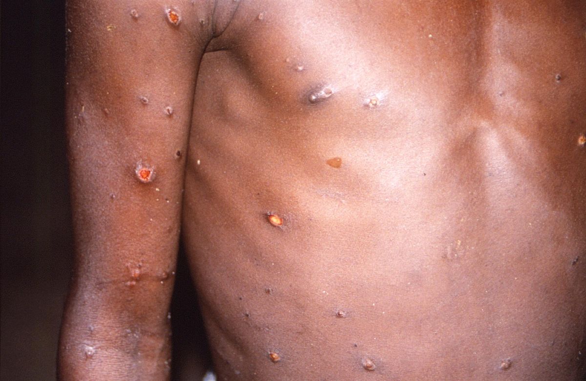 who-rules-out-monkeypox-becoming-a-pandemic-(for-now)