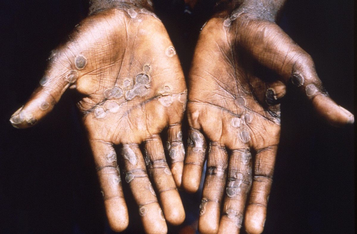 monkeypox:-who-is-most-likely-to-get-the-disease