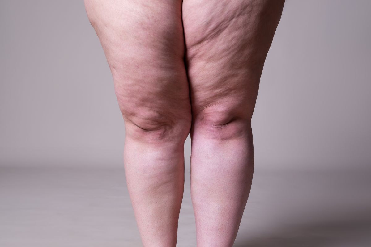 how-to-differentiate-lipedema-from-obesity