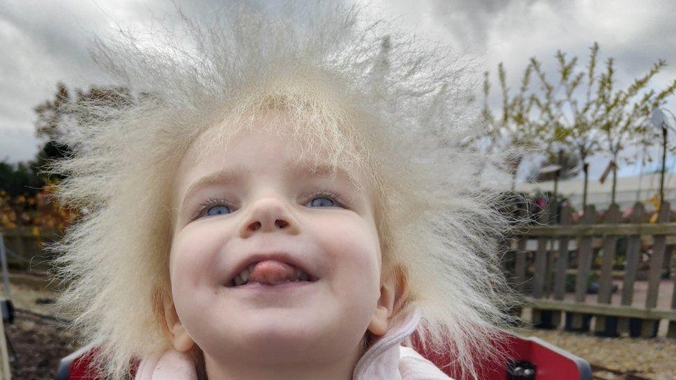 what-is-uncombable-hair-syndrome,-caused-by-a-genetic-mutation?